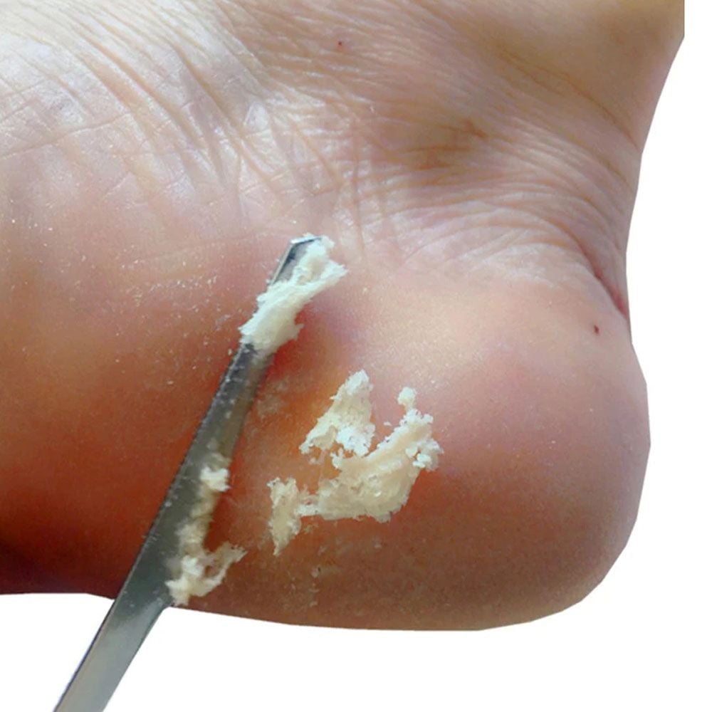 [리뷰] 각질나이프 페디큐어 발가락 손톱 면도기 캘러스 케어 각질나이프 GD14553 비교·체크리스트 가이드